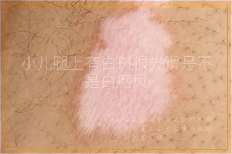 小儿腿上有白斑很光滑是不是白癜风