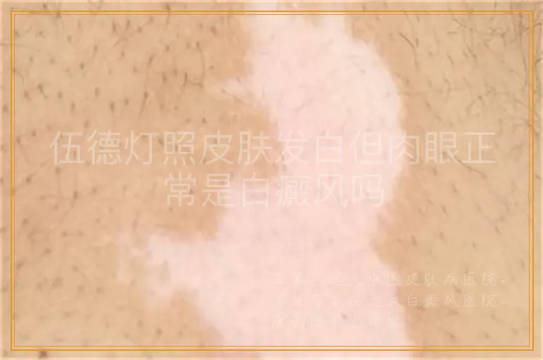 伍德灯照皮肤发白但肉眼正常是白癜风吗