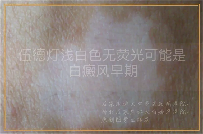 伍德灯浅白色无荧光可能是白癜风早期
