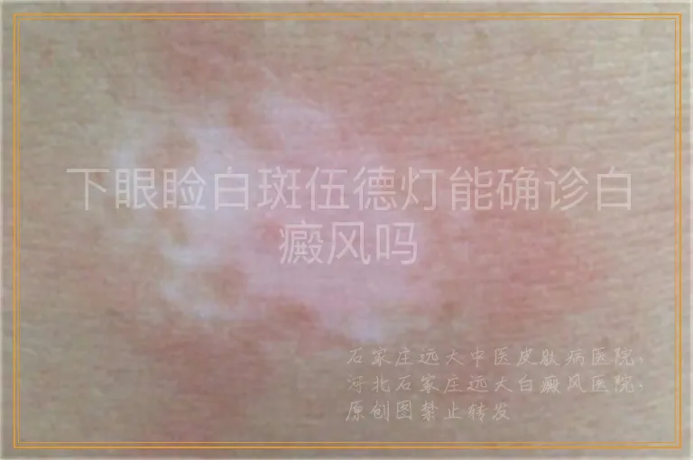下眼睑白斑伍德灯能确诊白癜风吗