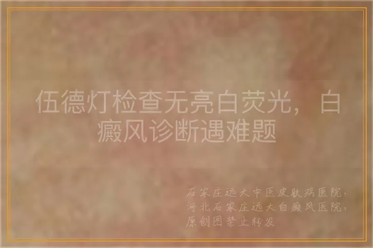 伍德灯检查无亮白荧光，白癜风诊断遇难题