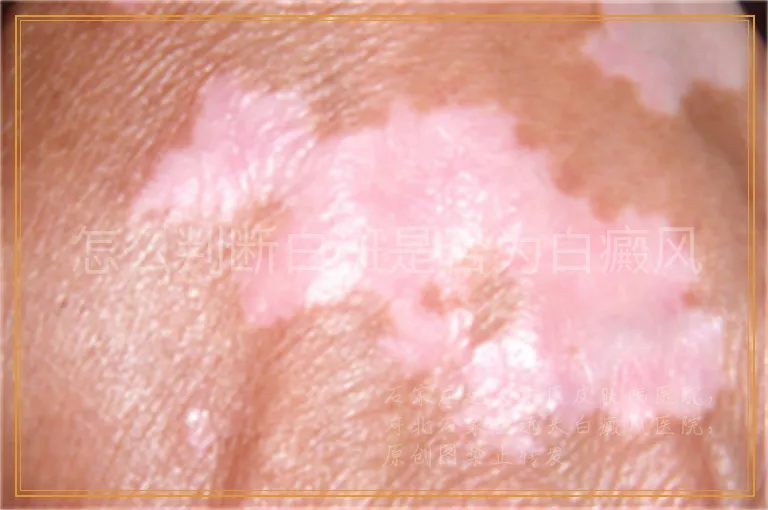 怎么判断白斑是否为白癜风