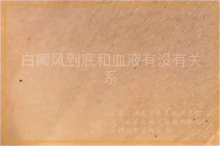 白癜风到底和血液有没有关系