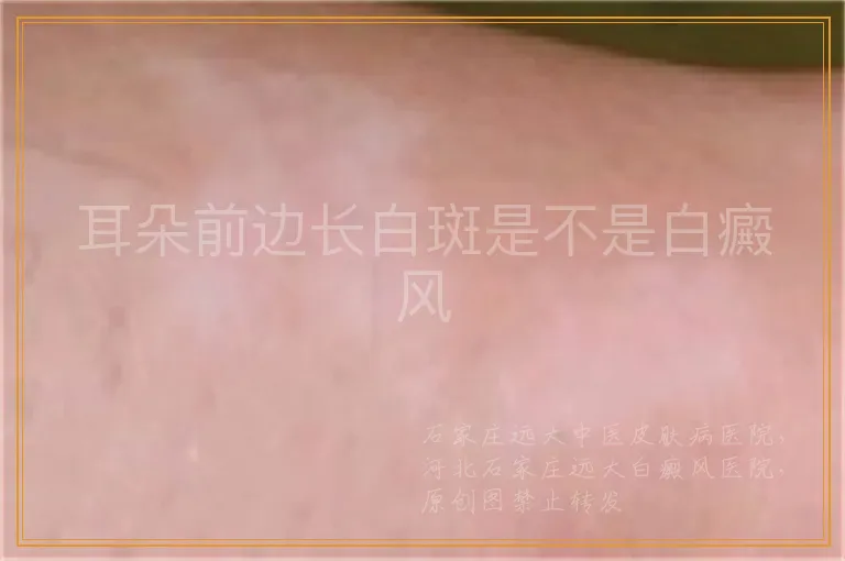 耳朵前边长白斑是不是白癜风