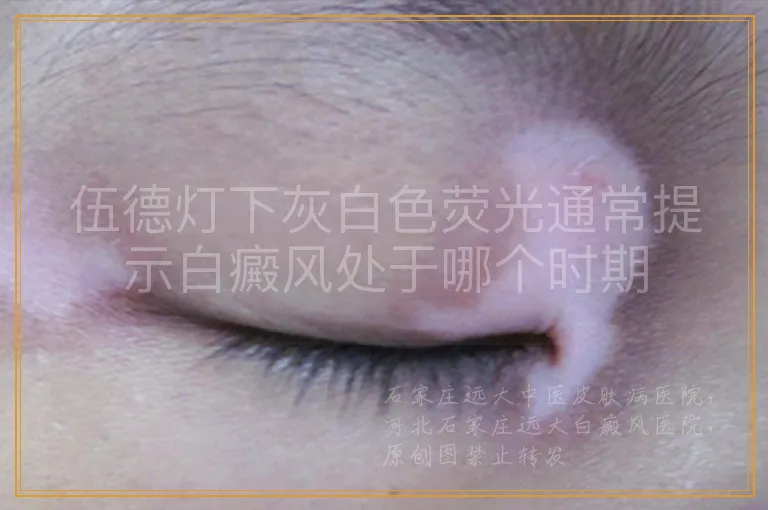 伍德灯下灰白色荧光通常提示白癜风处于哪个时期