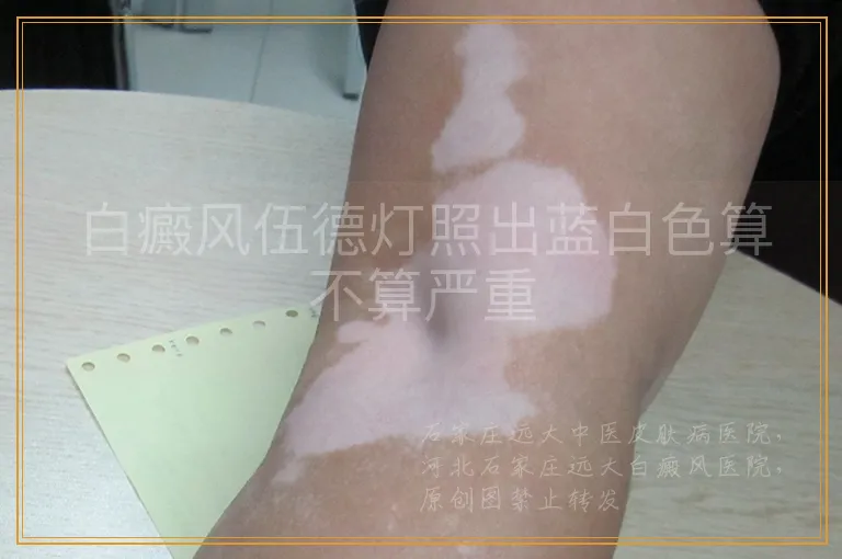 白癜风伍德灯照出蓝白色算不算严重