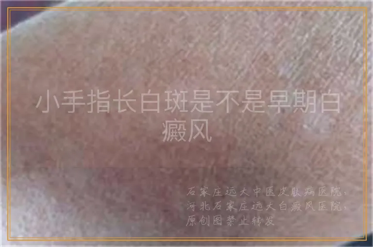 小手指长白斑是不是早期白癜风
