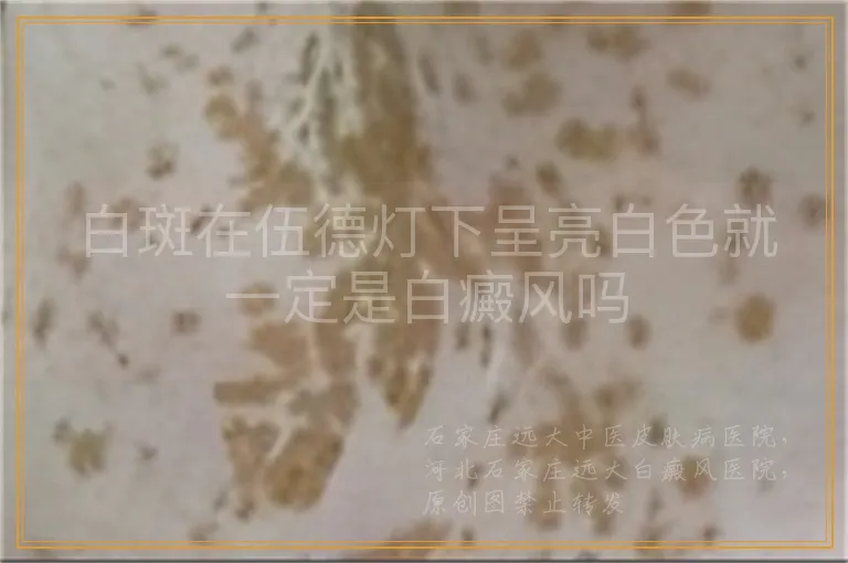 白斑在伍德灯下呈亮白色就一定是白癜风吗