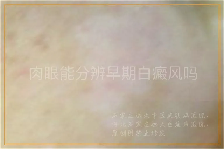 肉眼能分辨早期白癜风吗