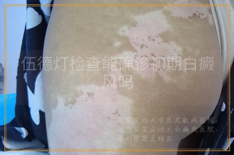 伍德灯检查能确诊初期白癜风吗