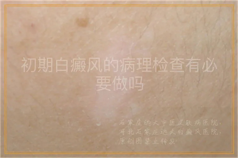 初期白癜风的病理检查有必要做吗
