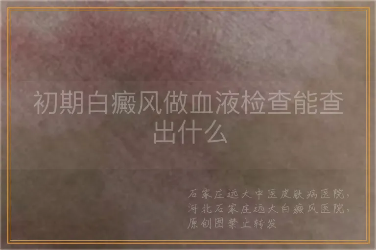 初期白癜风做血液检查能查出什么