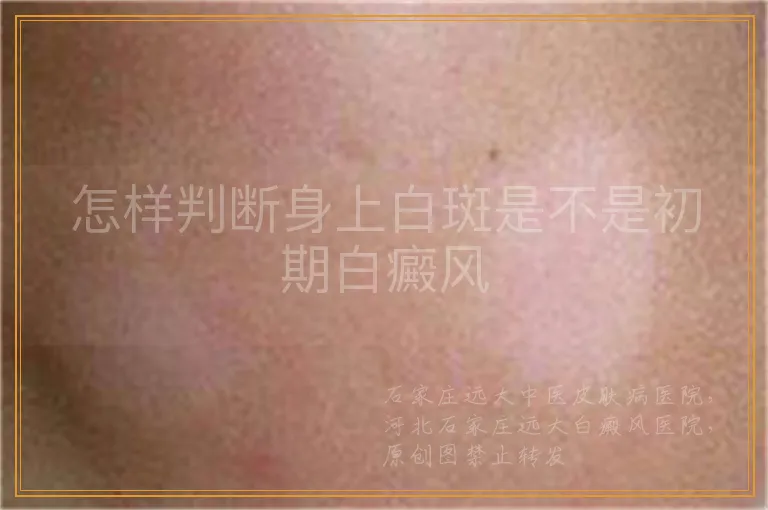怎样判断身上白斑是不是初期白癜风