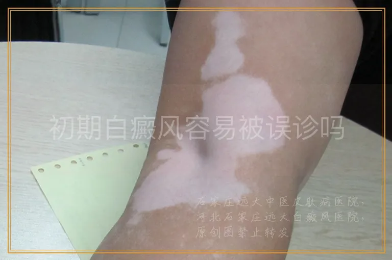 初期白癜风容易被误诊吗