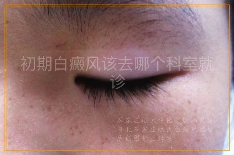 初期白癜风该去哪个科室就诊