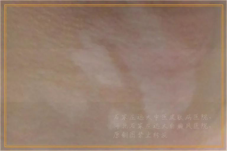 白癜风白斑初期怎么治比较有效果
