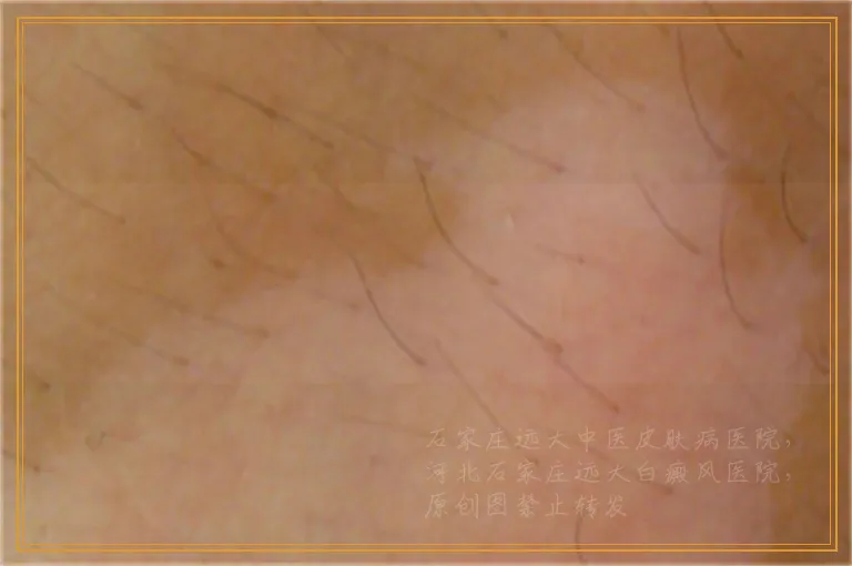 儿童白癜风治好后再次复发怎么回事