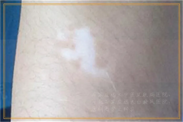 8岁孩子刚长白癜风乳白色怎么治好