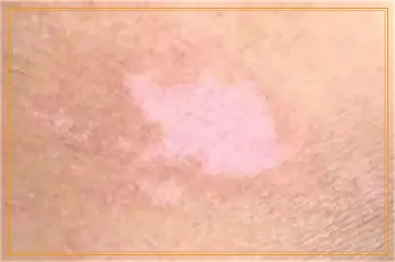 精神刺激导致的白癜风能治好吗