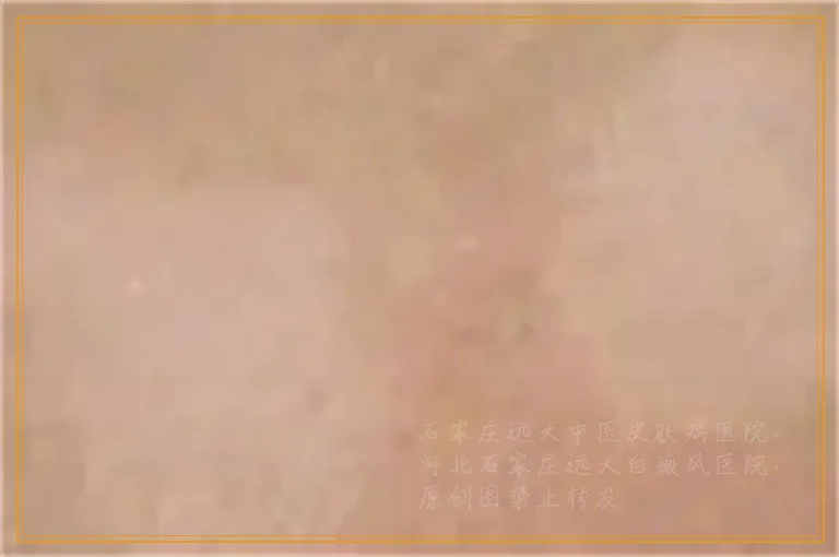 头部有大一块白癜风怎么治好