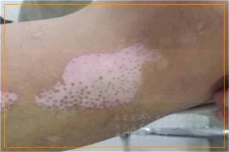 白癜风照308激光多长时间能治好