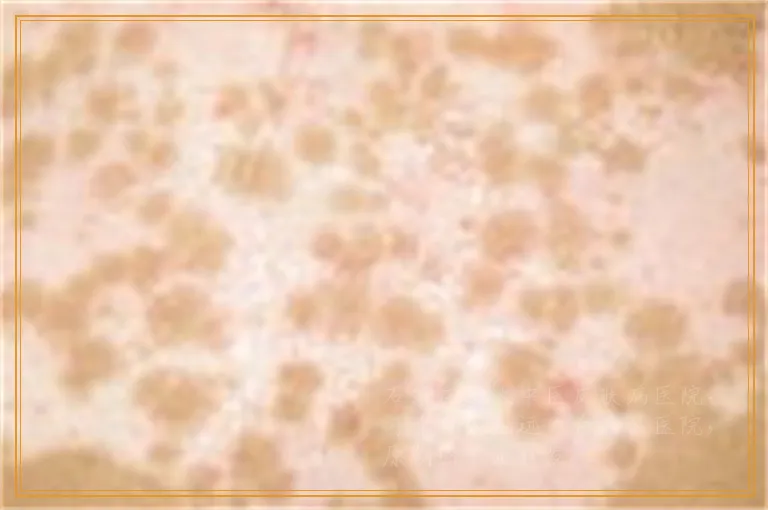 光吃中药能不能治好白癜风