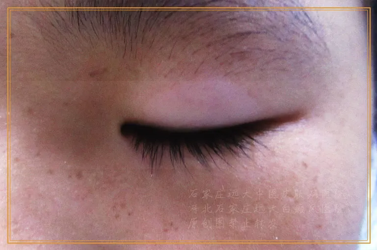 身上有白斑怎么治疗用308效果好吗