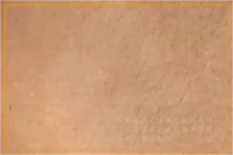 三个月的白点不吃激素可以治好吗