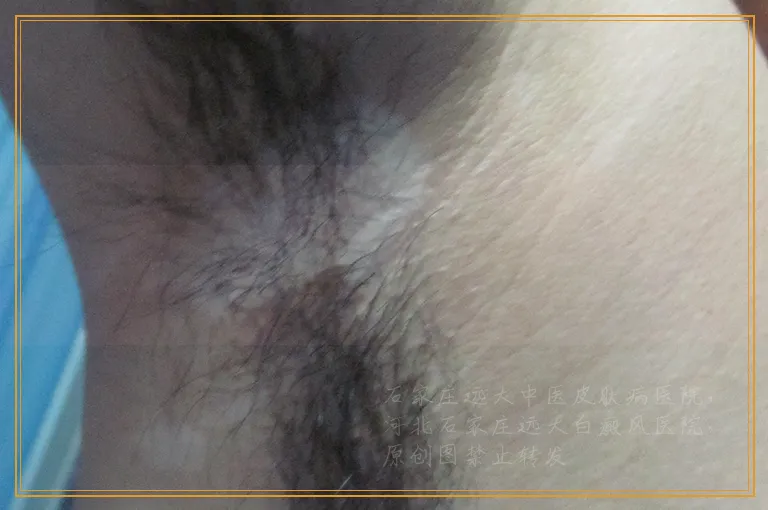 脚面白癜风应该用什么方法治疗