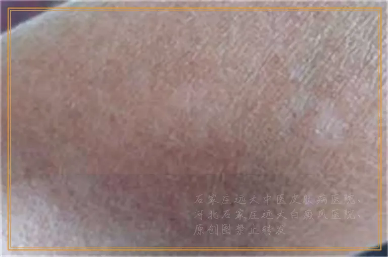 孩子手上白癜风怎么治