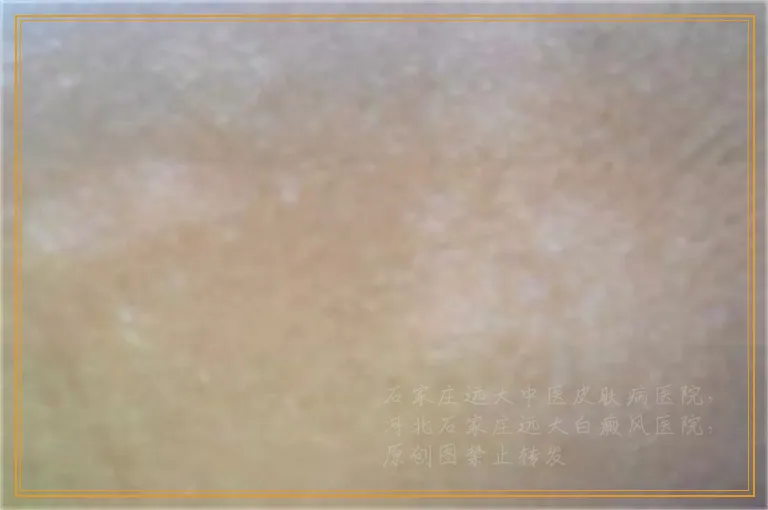 白癜风治好了还会不会复发