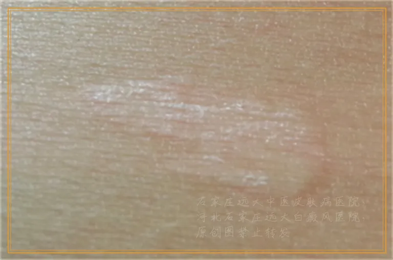 他克莫司真的能治好白癜风吗