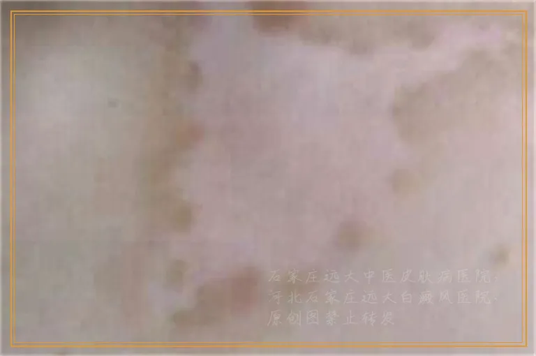 孩子白癜风治好别处又长新的怎么办
