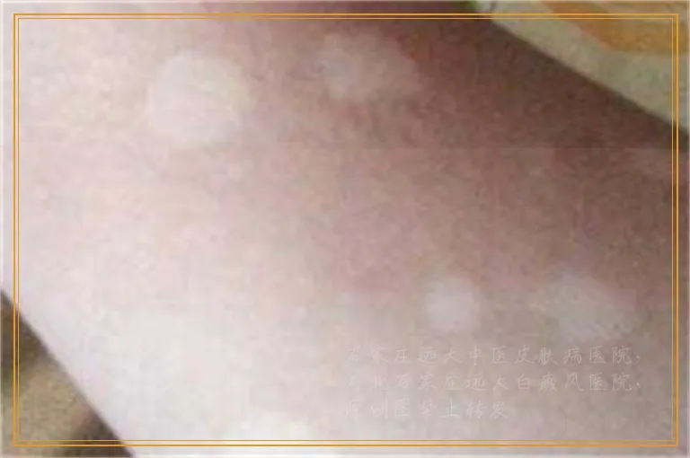 孩子腿部有白癜风能治好吗