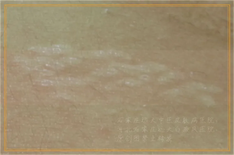 孩子脸上的白斑能否尽快治好