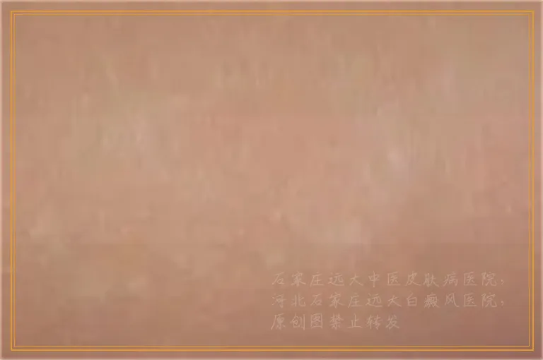 发展期白癜风怎么治比较好