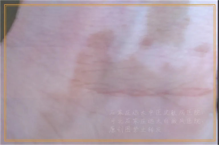 脸上头皮都有白癜风得花多少钱能治好