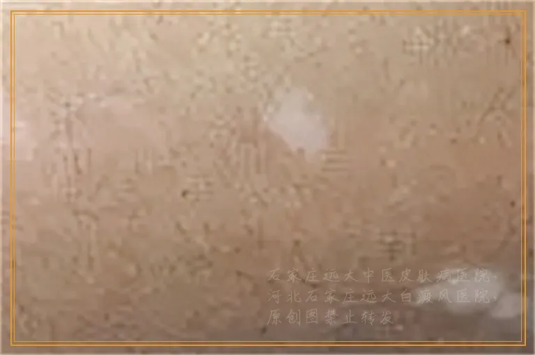 用火针治好手上白癜风的案例