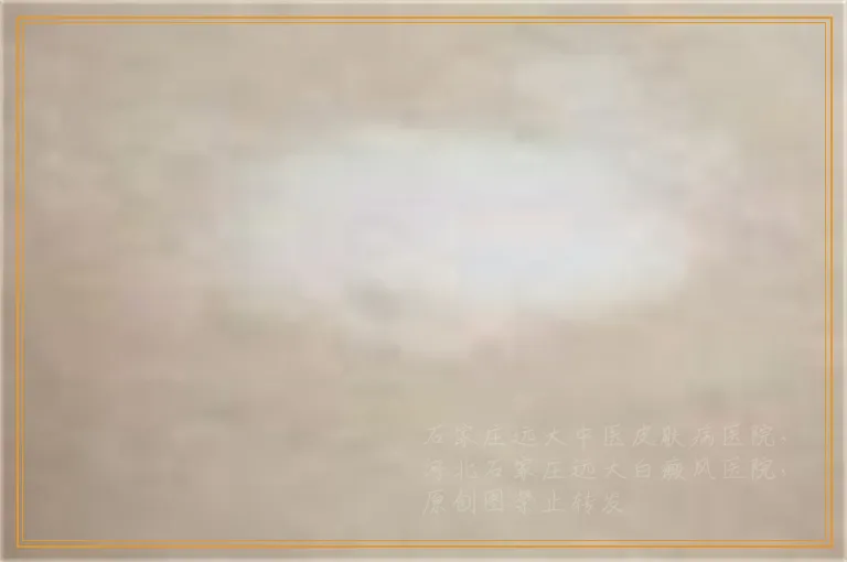 头发里有白斑越来越多怎么治疗