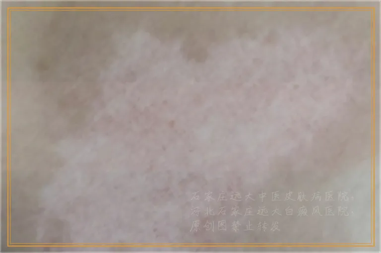 1元硬币大小的白癜风用什么方法治