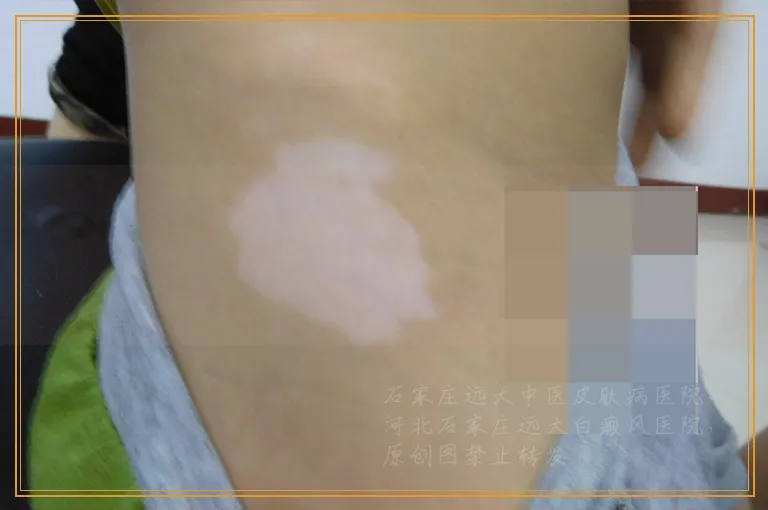 孩子6岁阴茎上一块白斑该怎么治