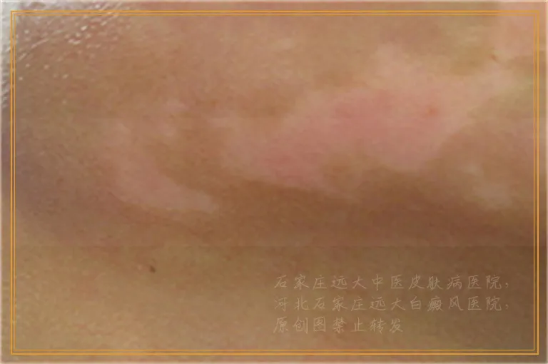 脑袋上长白癜风怎么治比较好