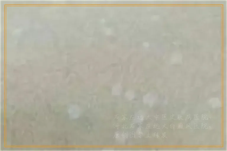 白癜风激光治疗效果和剂量大小有关吗