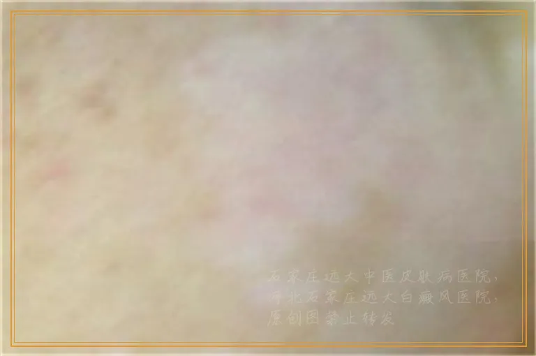 白癜风照光一次需要收费多少