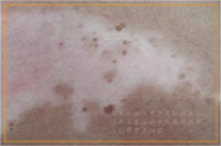 白癜风照光后为什么会脱皮