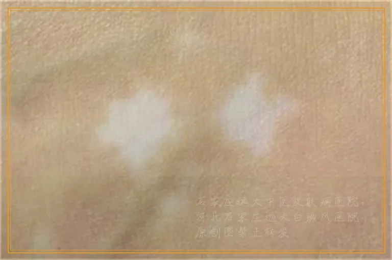 白癜风不治疗会患什么并发症