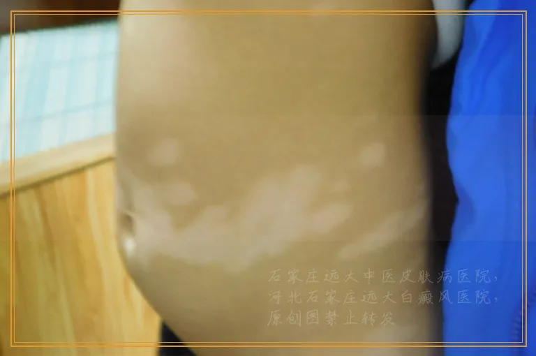 治疗白癜风的311是什么