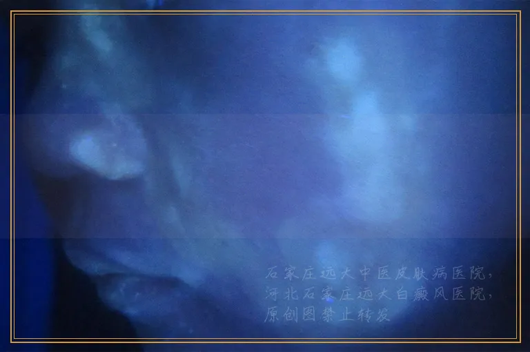 哪种类型的白癜风照激光效果好