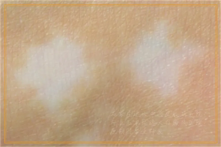 河北哪里治疗手臂白斑比较好