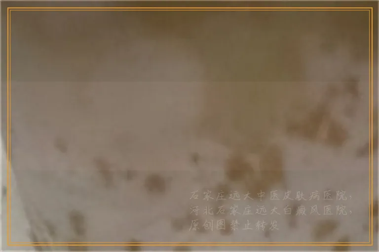 卤米松和他克莫司相比较哪个治疗白癜风好